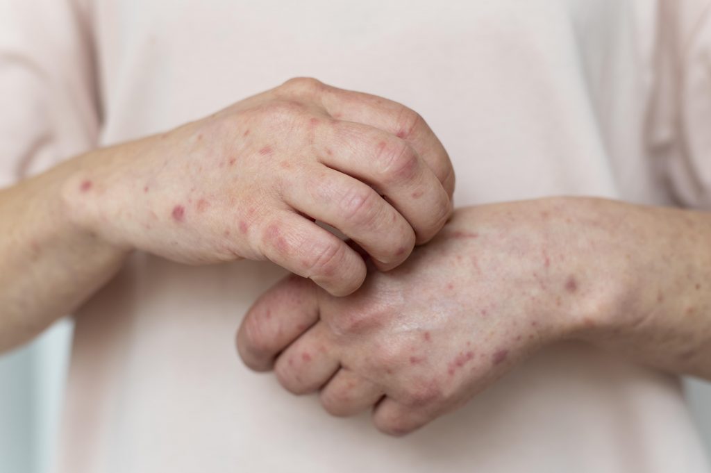 Skin Allergy Person S Arm 1024X681